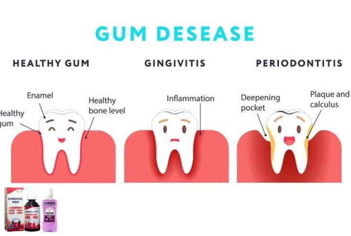 Common Causes of Gum Disease and How to Prevent Them