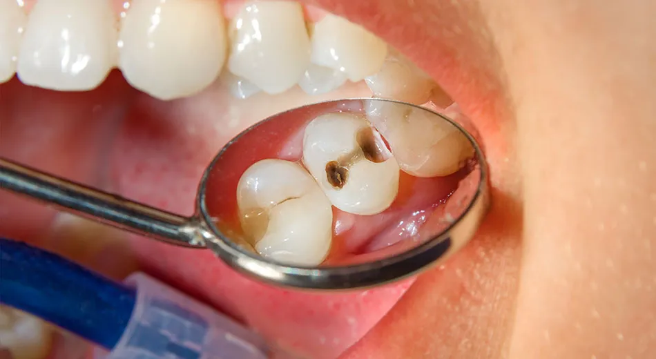 What is Tooth Decay, and Why is It Important