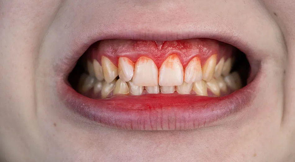 What are Gum Disease, Gingivitis, and Periodontitis?